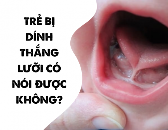 Trẻ bị dính thắng lưỡi có nói được không?