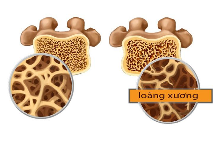 Dấu hiệu thừa vitamin D3 ở trẻ sơ sinh