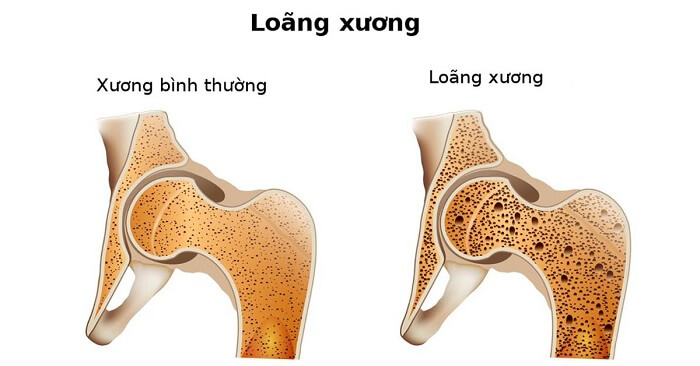 Tác dụng tinh dầu hoa anh thảo phòng ngừa loãng xương