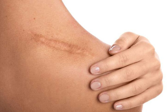 Uống collagen có tác dụng giúp da nhanh liền sẹo